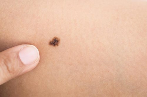 Edukacija i pregledi za rano otkrivanje melanoma 13.4.2024.